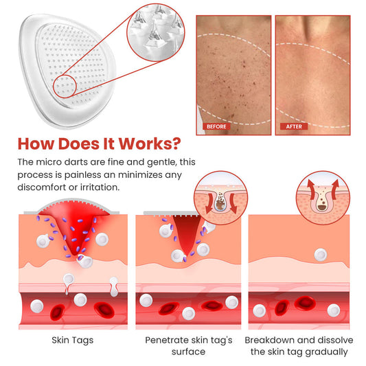 DermaSmooth Skin Tag Remover